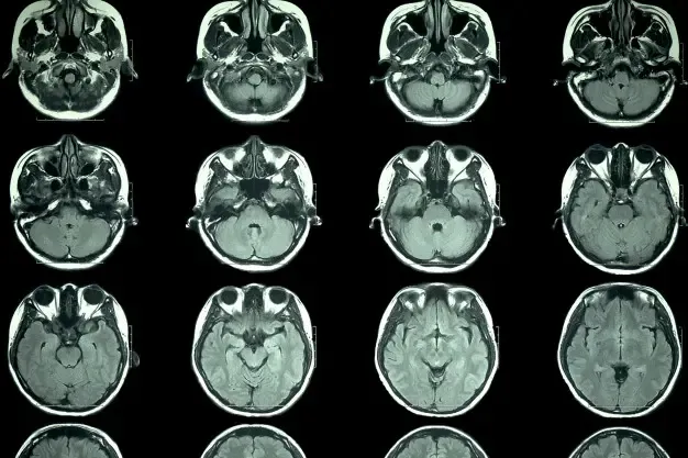 An MRI scan can be used to investigate tinnitus in the NHS